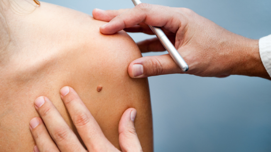The 5 Key Features of Melanoma & How to Self-Screen